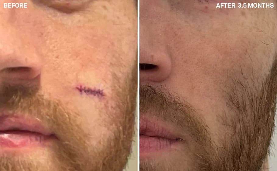 Before and after, After 3.5 Months, for Scars & Healing — Alex