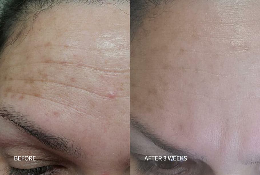 Uneven Tone & Dark Spots