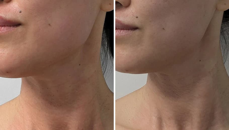 Before and after — Rachel W., 8 Weeks