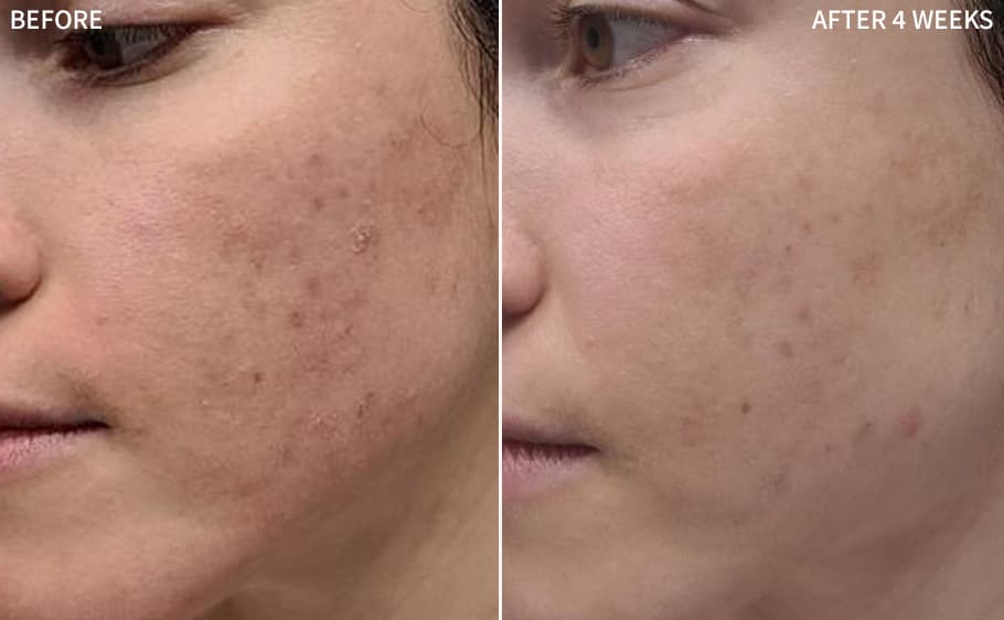 Before and after, After 4 Weeks, for Daily Skin Health — Lauren B.