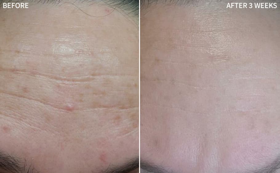 Before and after — Jennifer K., 12 Weeks