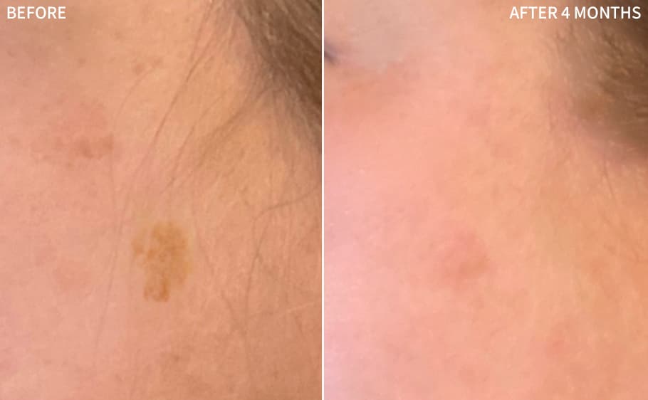 Before and after — Lisa H., 10 Weeks