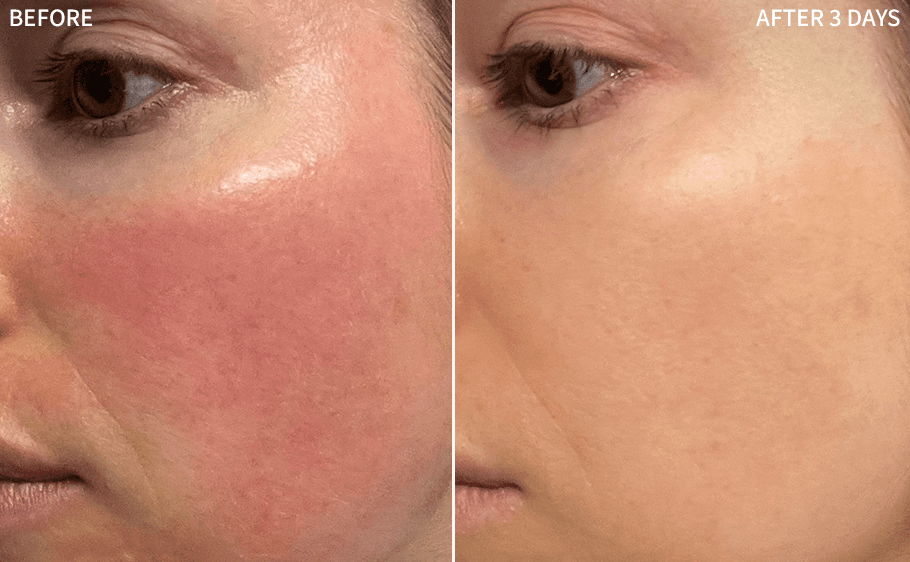 Before and after — Diana M., 3 Weeks