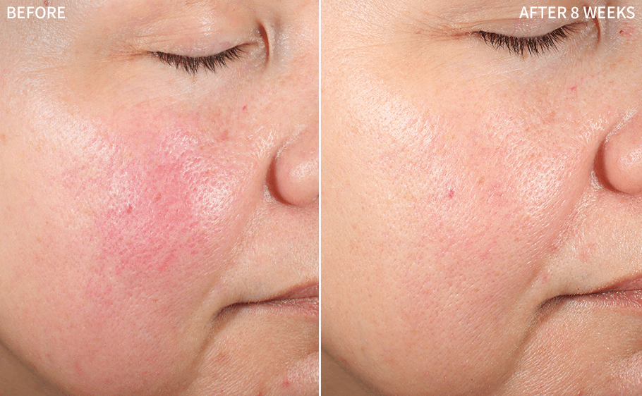 Redness & Rosacea