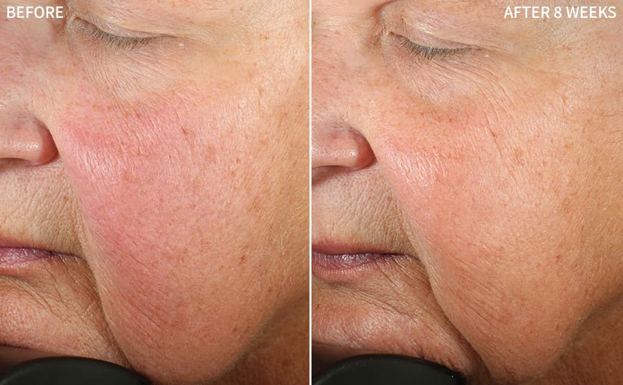 Before and after, After 8 Weeks, for Redness & Rosacea