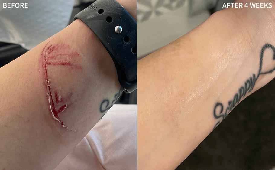 Before and after, After 4 Weeks, for Scars & Healing — B.H.